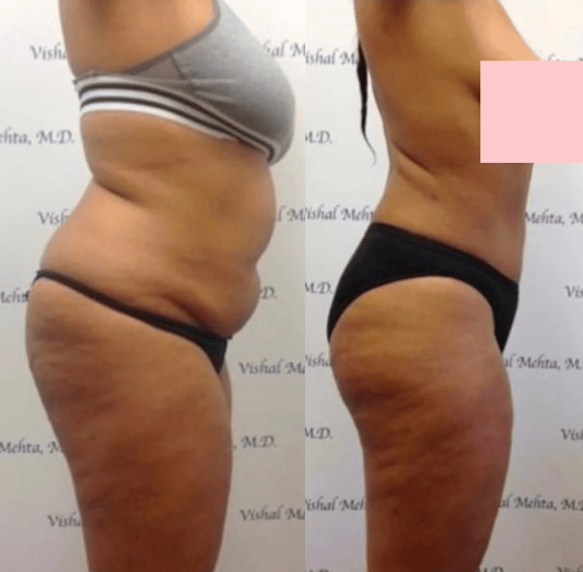Before & after results of awake mini-tummy tuck and liposuction, lipo-sculpting performed by Dr. Vishal Mehta, top Liposuction Surgeon, Central NJ