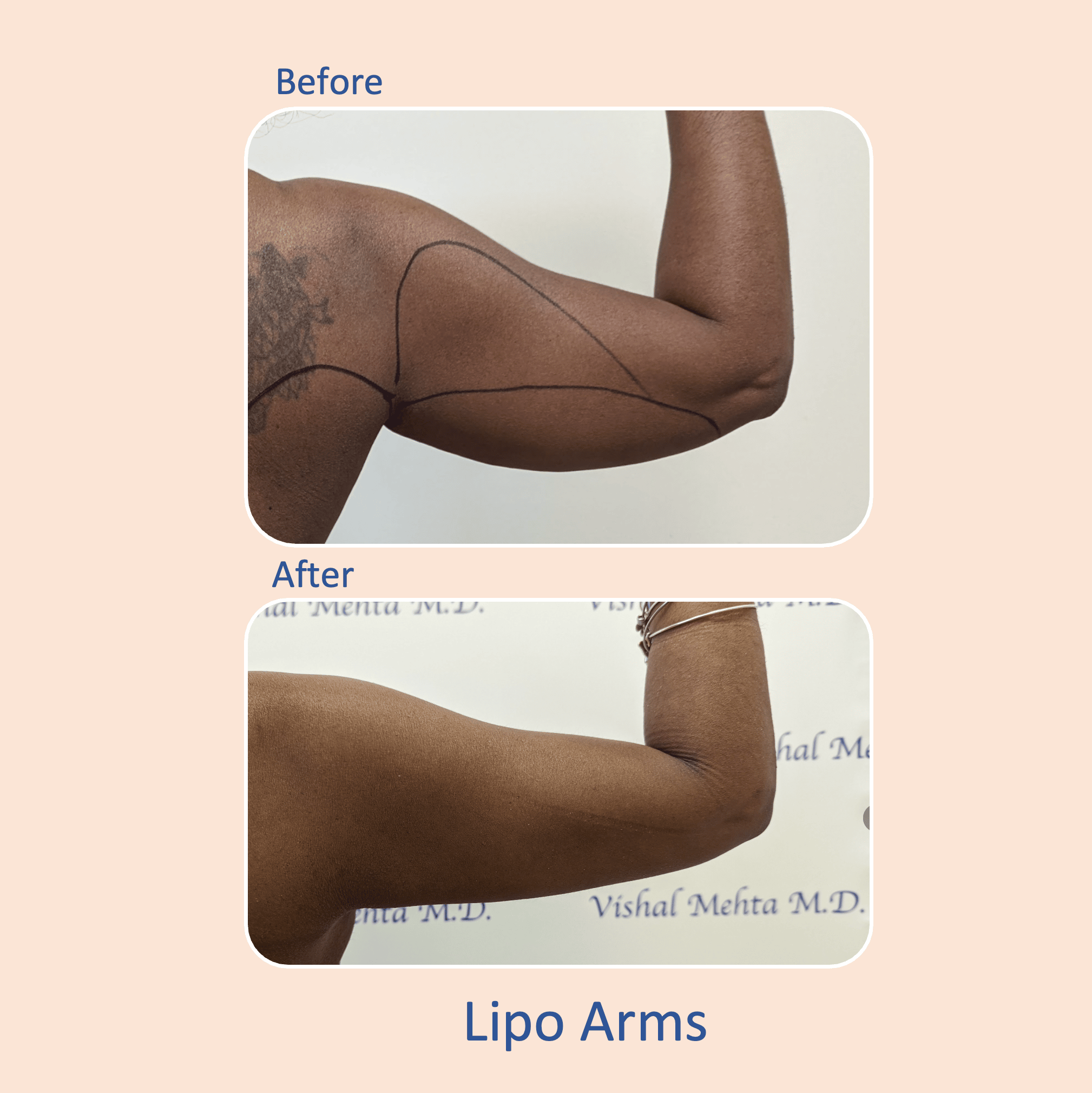 Before & after results of awake liposuction, lipo-sculpting performed by Dr. Vishal Mehta, top Liposuction Surgeon, Central NJ