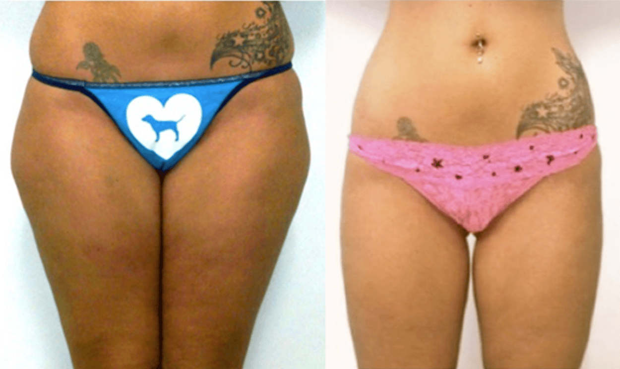 Before & after results of  liposuction of thighs, lipo-sculpting performed by Dr. Vishal Mehta, top Liposuction Surgeon, Central NJ