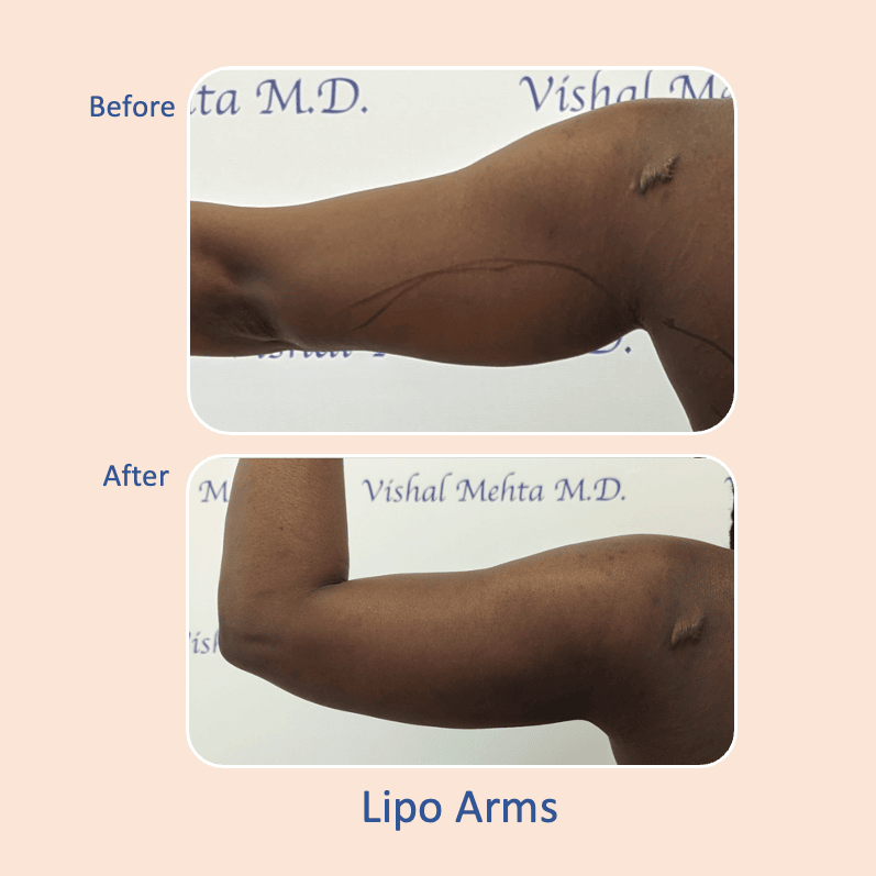 Before & after results of awake liposuction, lipo-sculpting performed by Dr. Vishal Mehta, top Liposuction Surgeon, Central NJ