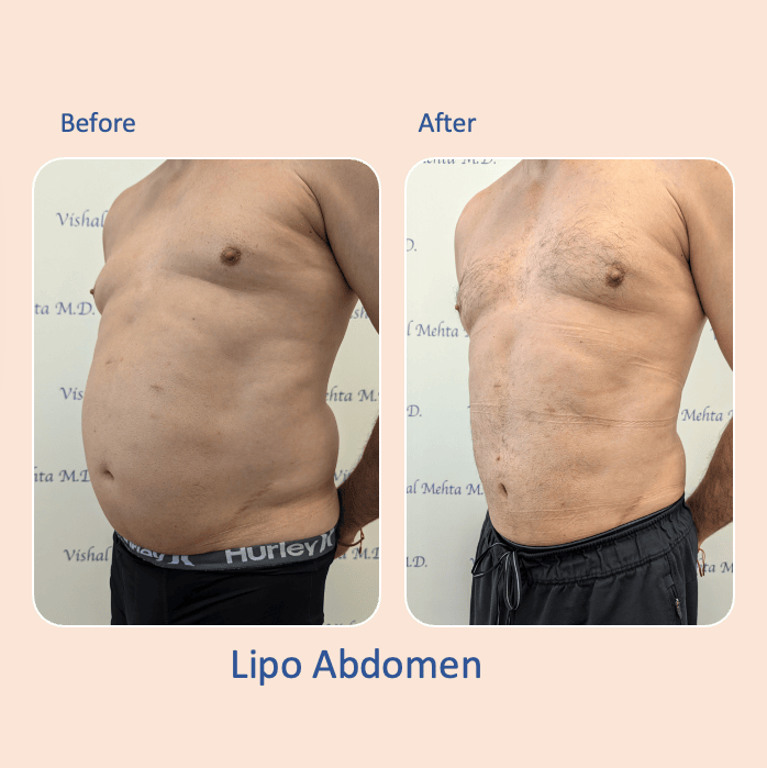 Before & after results of awake liposuction, lipo-sculpting performed by Dr. Vishal Mehta, top Liposuction Surgeon, Central NJ