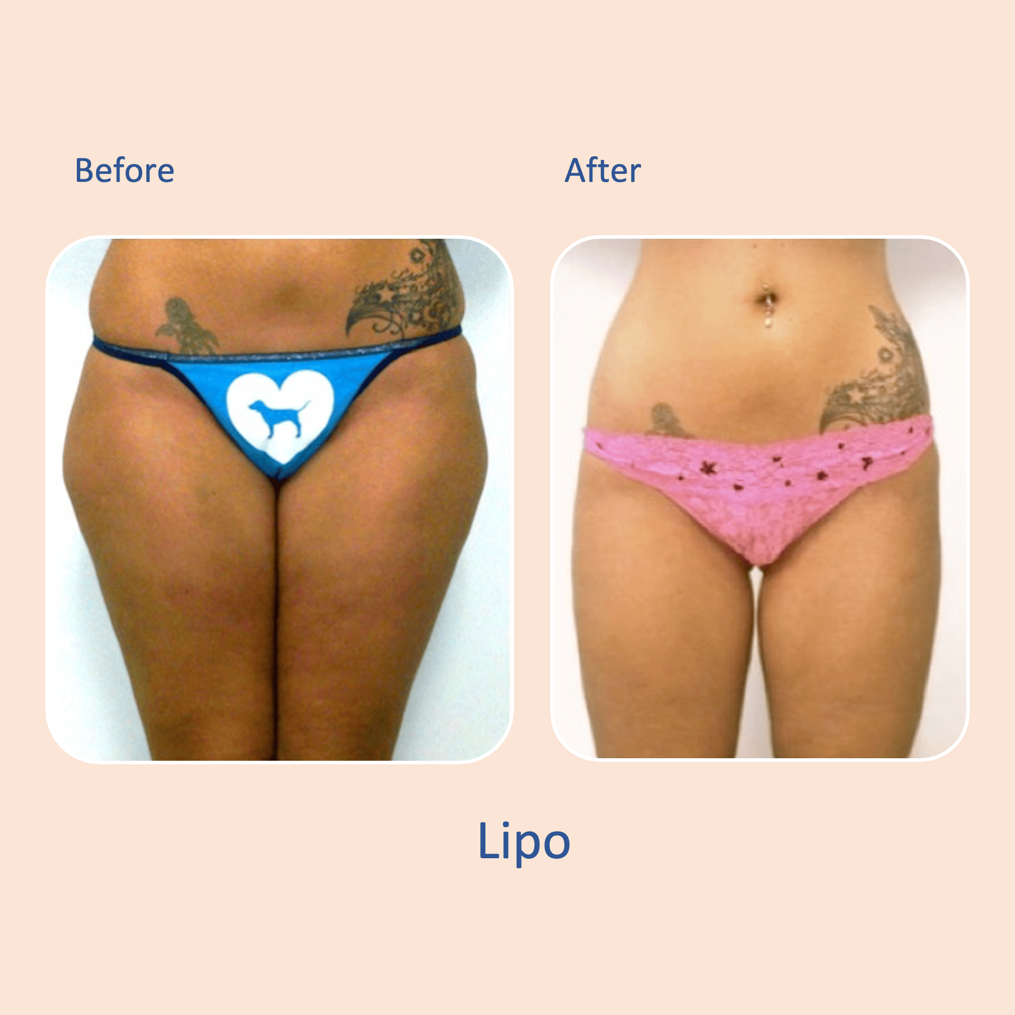 Before & after results of awake liposuction, lipo-sculpting performed by Dr. Vishal Mehta, top Liposuction Surgeon, Central NJ