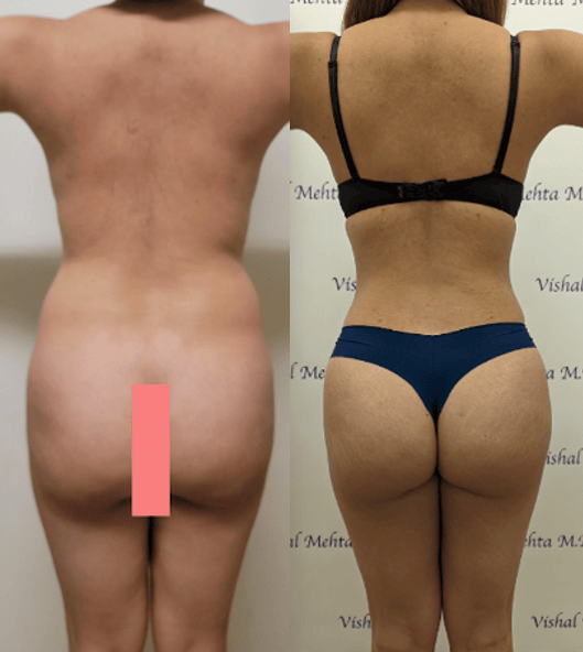 Before & after results of awake liposuction, lipo-sculpting and fat transfer to buttocks, Brazilian Butt Lift, BBL performed by top Liposuction Surgeon, Central NJ