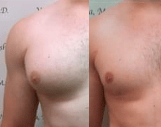 Before & after results of awake liposuction, lipo-sculpting gynecomastia, male chest, performed by Dr. Vishal Mehta, top Liposuction Surgeon, Central NJ