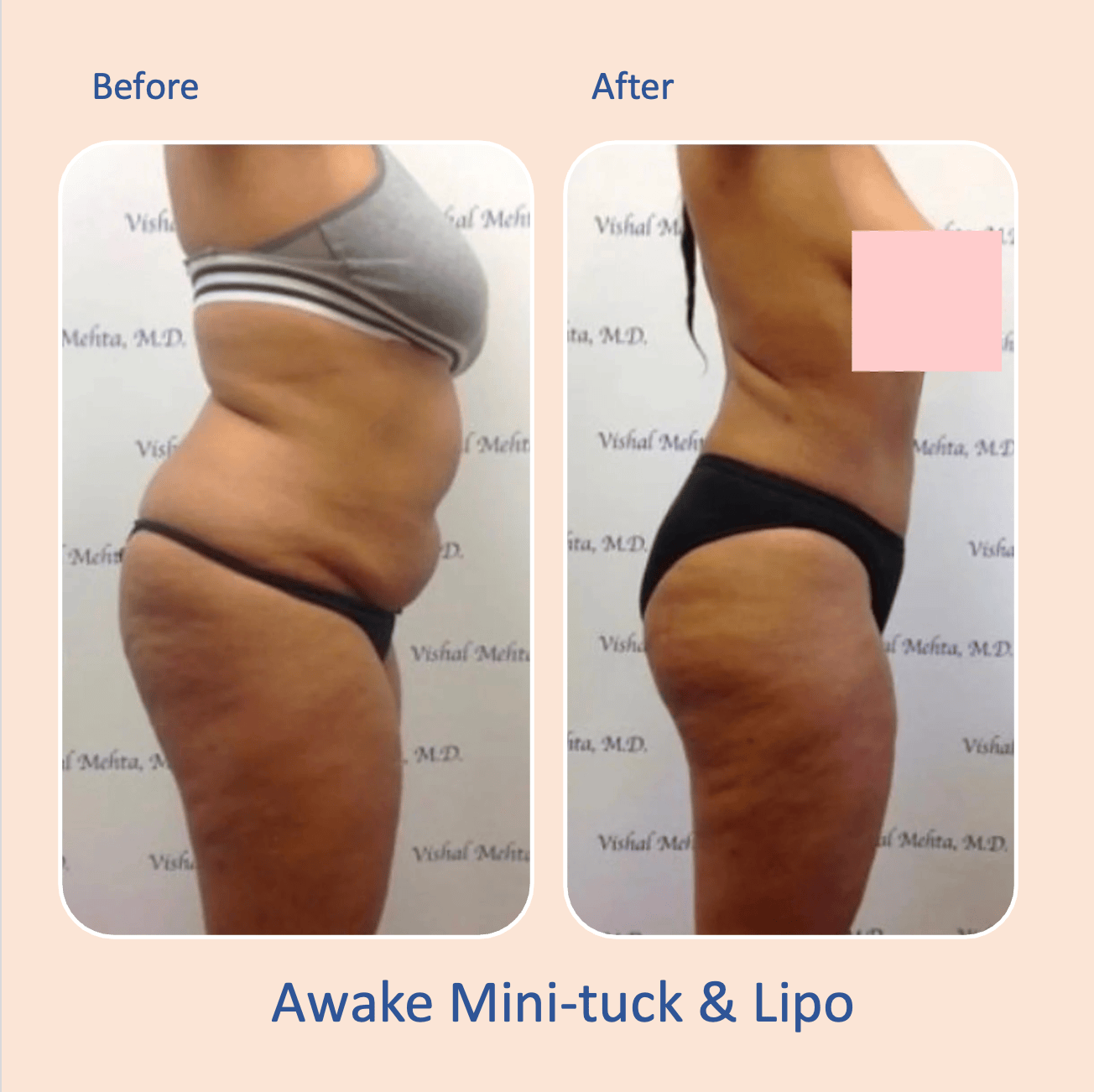 Before & after results of awake mini-tummy tuck and liposuction performed by Dr. Vishal Mehta, top Liposuction Surgeon, Central NJ