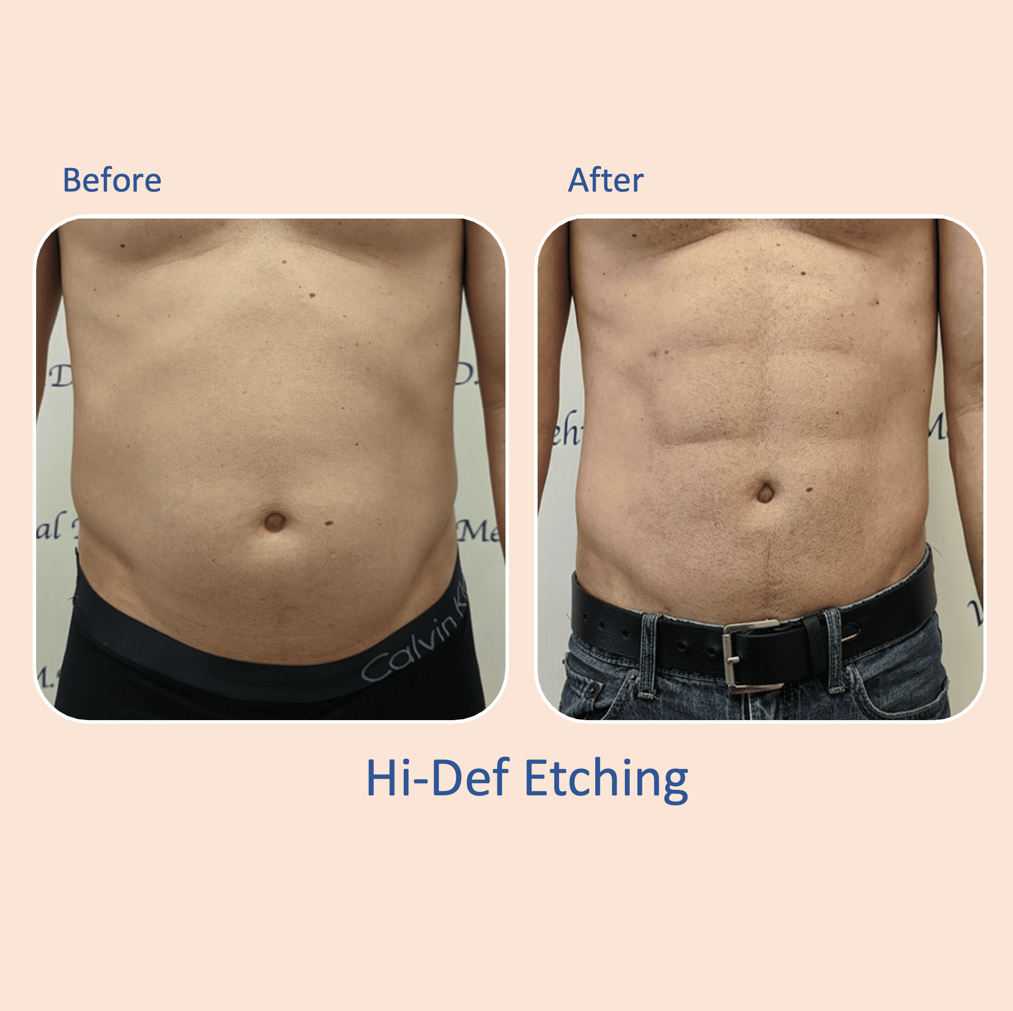 Before & after results of awake hi-def Hi-definition liposuction, lipo-sculpting, 6-pack etching performed by Dr. Vishal Mehta, top Liposuction Surgeon, Central NJ