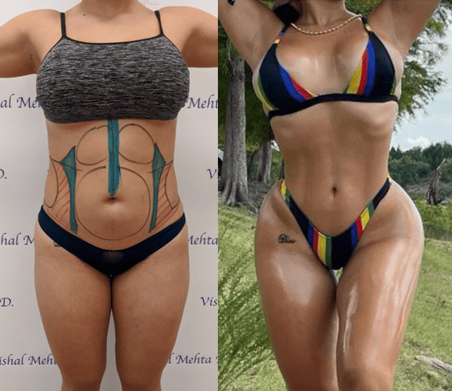 Before & after results of awake hi-def Hi-definition liposuction, lipo-sculpting, 6-pack etching performed by Dr. Vishal Mehta, top Liposuction Surgeon, Central NJ
