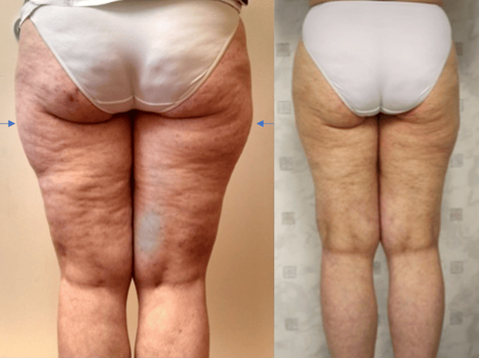 Before & after results of awake liposuction, lipo-sculpting, lipedema treatment performed by Dr. Vishal Mehta, top Liposuction Surgeon, Central NJ