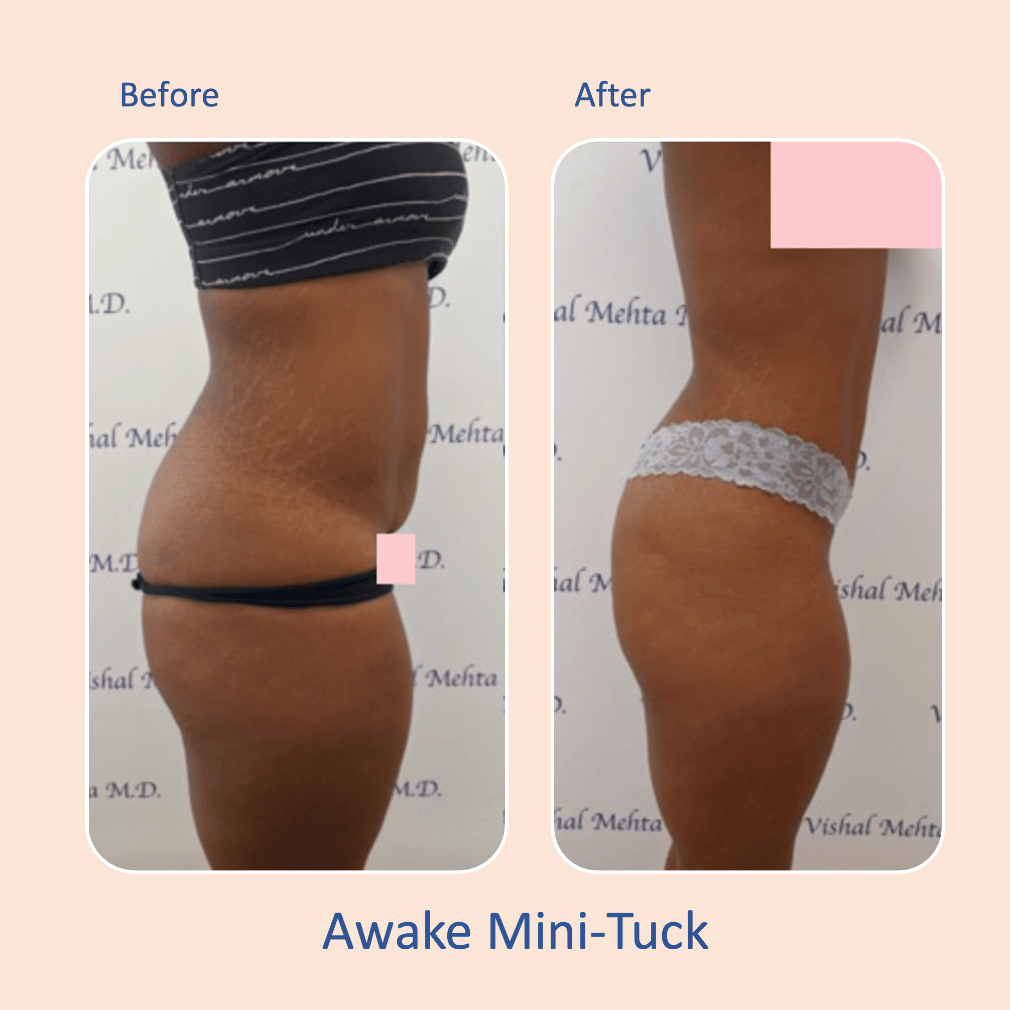 Before & after results of awake mini-tummy tuck and liposuction, lipo-sculpting performed by Dr. Vishal Mehta, top Liposuction Surgeon, Central NJ