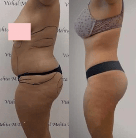 Before & after results of awake liposuction, lipo-sculpting and fat transfer performed by Dr. Vishal Mehta, top Liposuction Surgeon, Central NJ