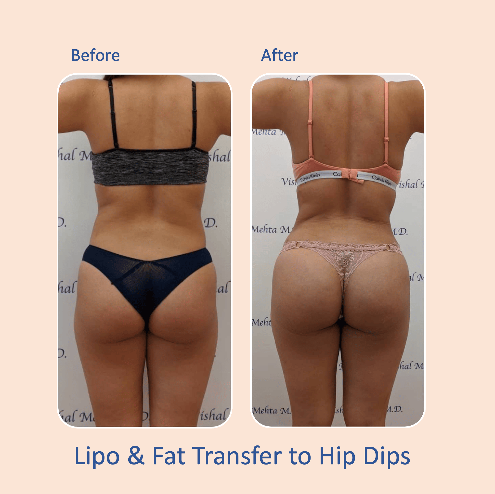 Before & after results of awake liposuction, lipo-sculpting performed by Dr. Vishal Mehta, top Liposuction Surgeon, Central NJ
