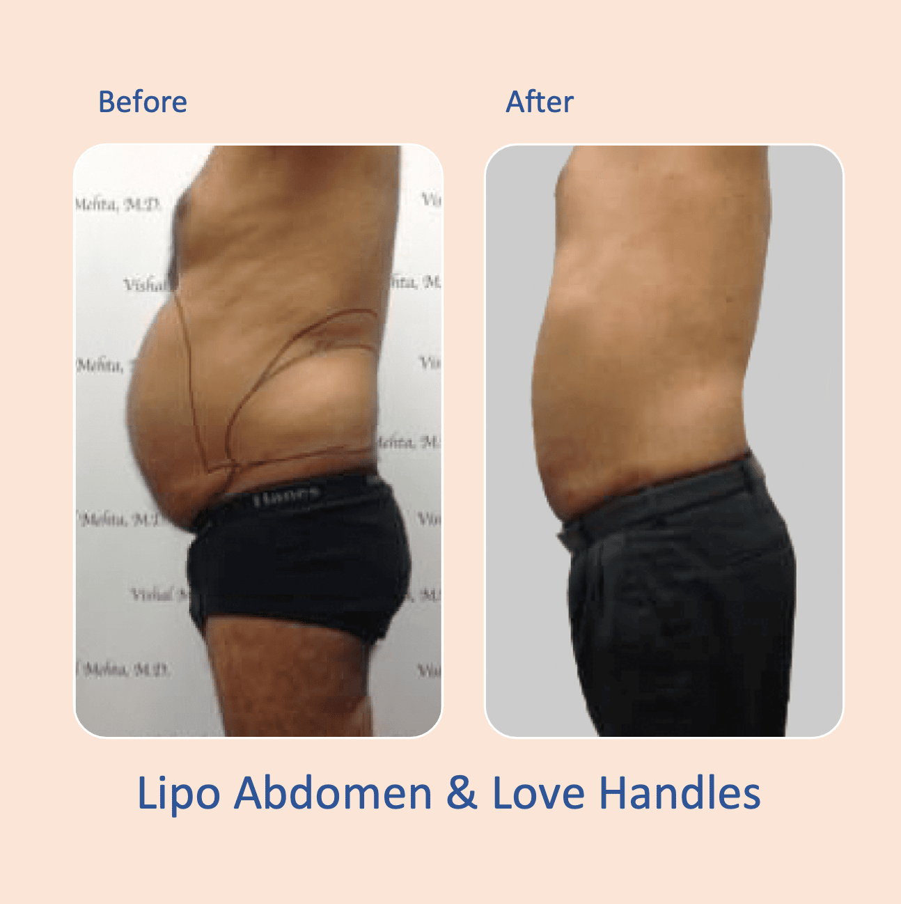 Before & after results of awake liposuction, lipo-sculpting performed by Dr. Vishal Mehta, top Liposuction Surgeon, Central NJ