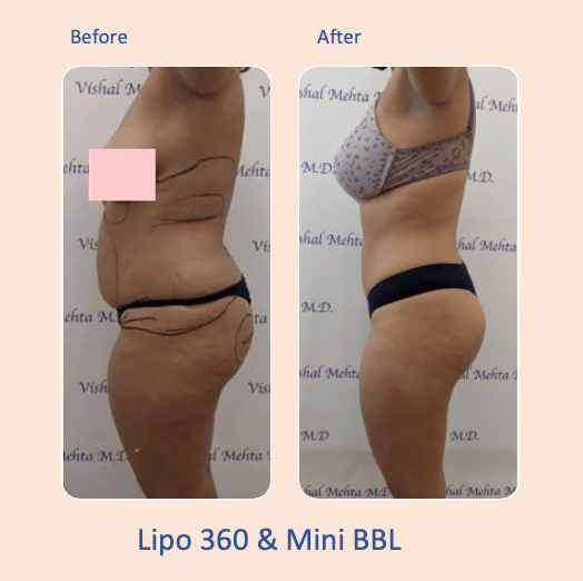 Before & after results of awake liposuction, lipo-sculpting and fat transfer to buttocks, Brazilian Butt Lift, BBL performed by top Liposuction Surgeon, Central NJ